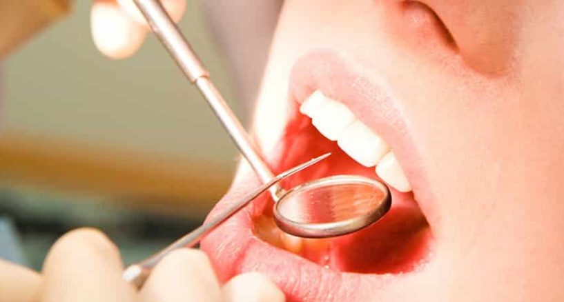 Everything one needs to know about teeth cleaning